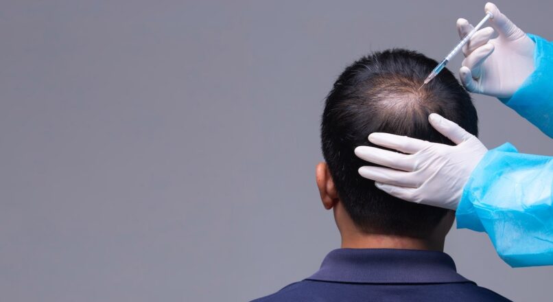 How many treatments of PRP for hair loss? – ROYAL COSMETIC SURGERY PK