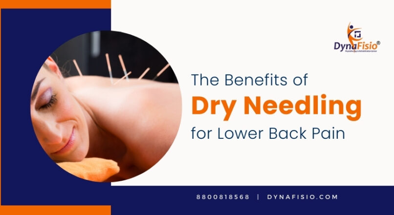 Exploring the Benefits of Dry Needling for Lower Back Pain