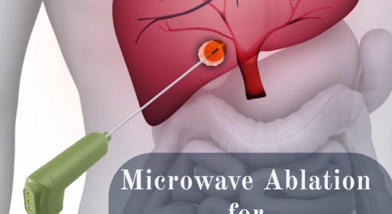 MICROWAVE ABLATION FOR TUMOURS