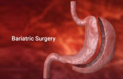 Benefits of Metabolic and Bariatric Surgery in Isb