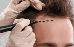 Investing in Confidence: A Comprehensive Guide to Hair Transplant Costs in Islamabad