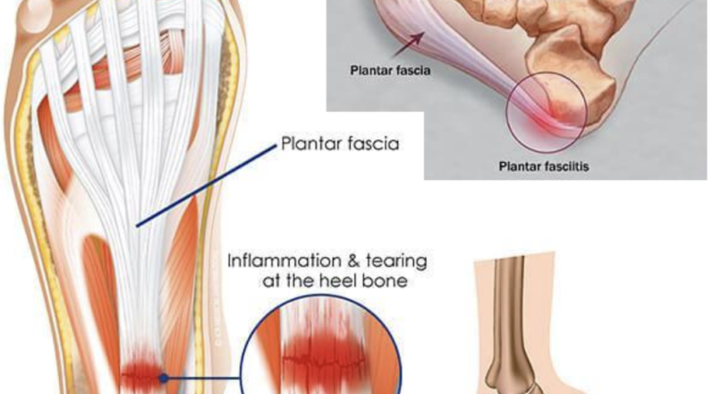 Plantar Fasciitis Relief: Effective Management Tips from ADAPT Recharge