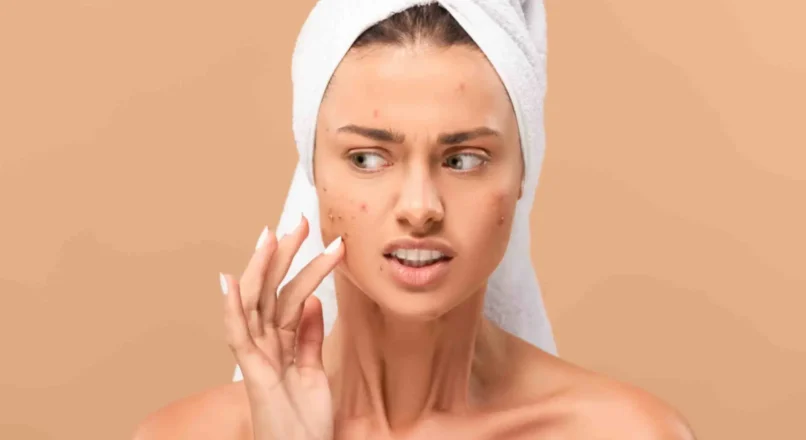 Are Acne Scars treatment in Islamabad Pakistan Permanent?